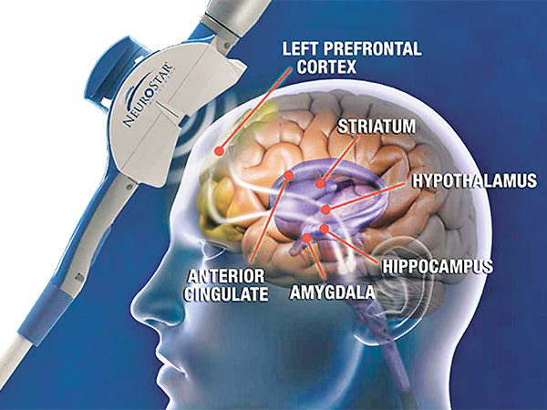 TMS: A novel treatment in neuro-psychiatry