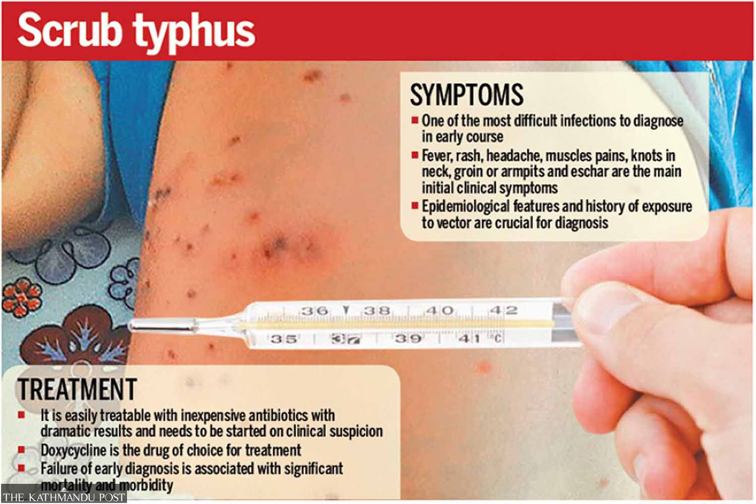 scrub-typhus-a-neglected-disease-emerging-as-new-health-challenge