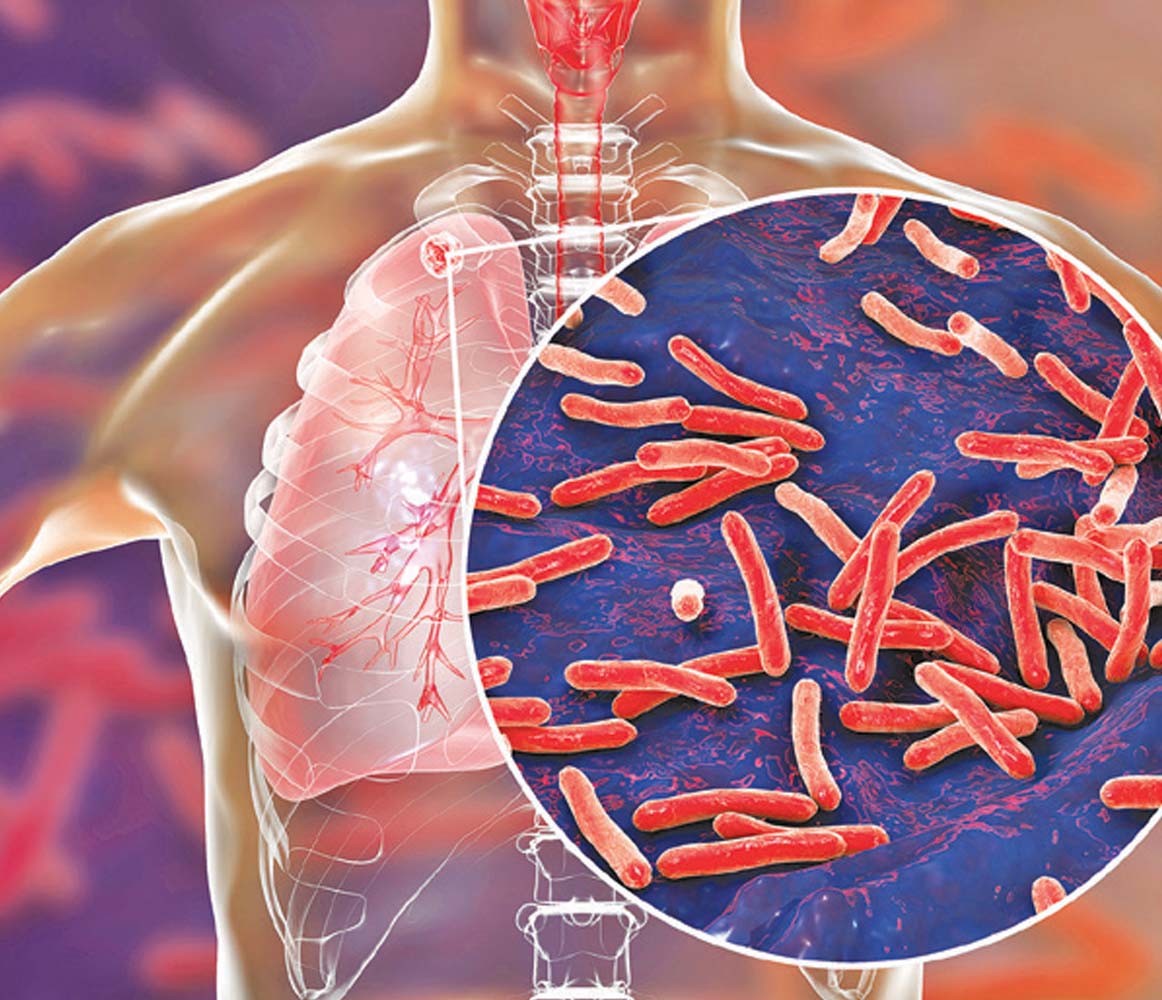 Health authorities clueless about over 31,000 tuberculosis patients