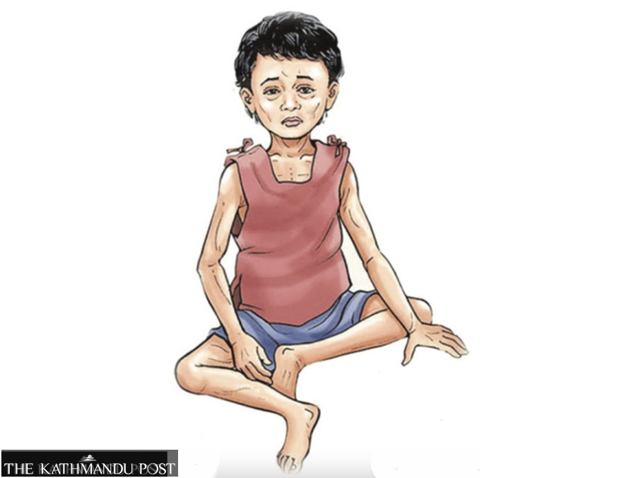 Over 1,500 children in Banke found malnourished