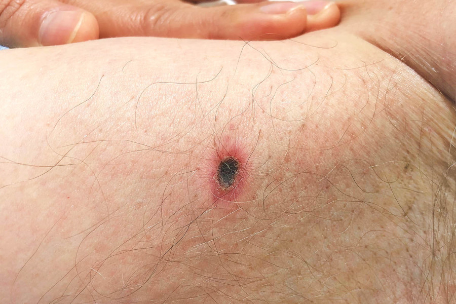 Kathmandu’s indoor scrub typhus outbreak